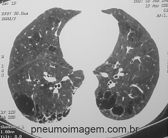 ESTUDO PODE DETERMINAR NOVO CRITÉRIO ESPIROMÉTRICO PARA A DEFINIÇÃO DA DPOC ESTUDO PODE DETERMINAR NOVO CRITÉRIO ESPIROMÉTRICO PARA A DEFINIÇÃO DA DPOC
